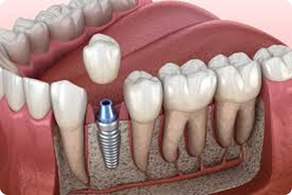 Single Tooth Implants