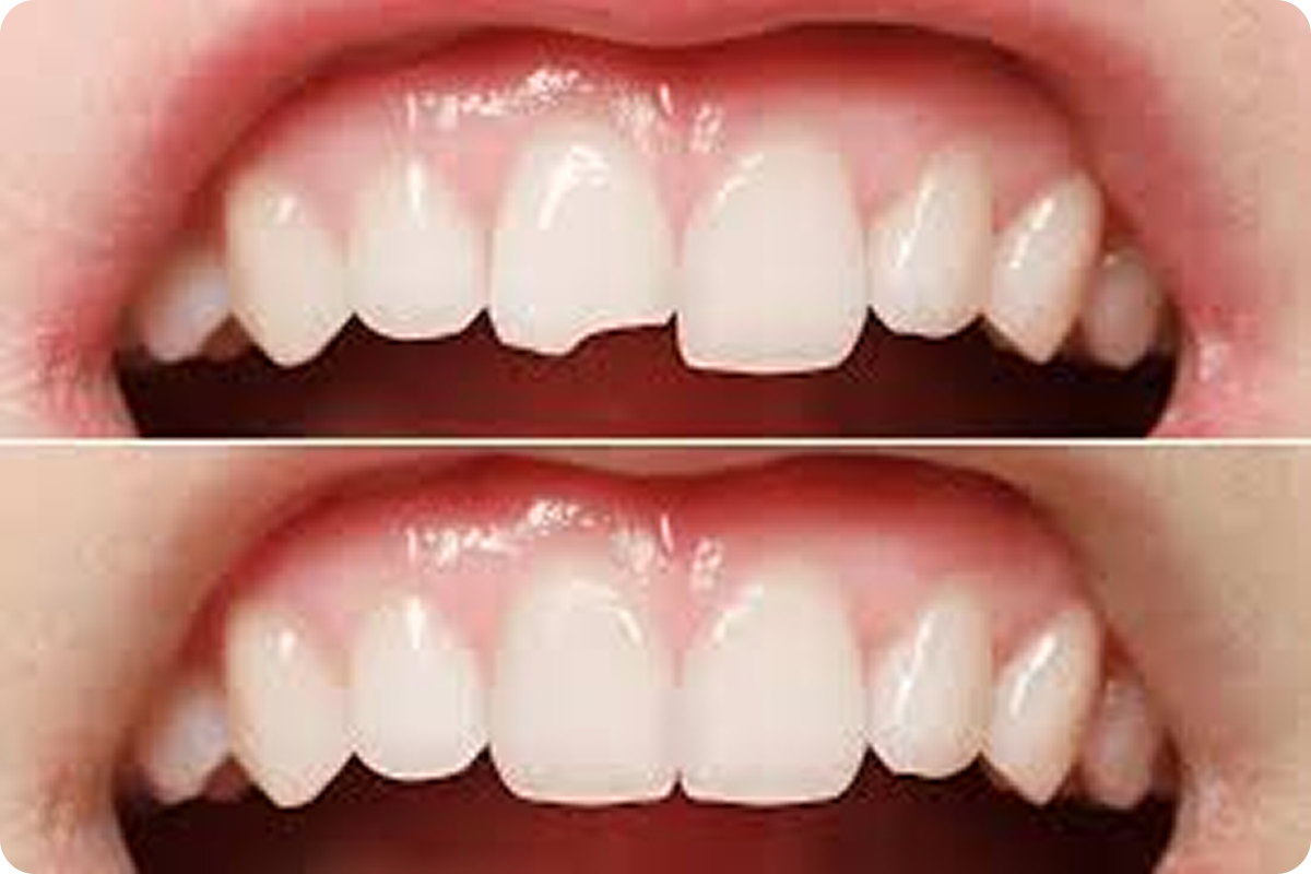 Broken Tooth Restoration