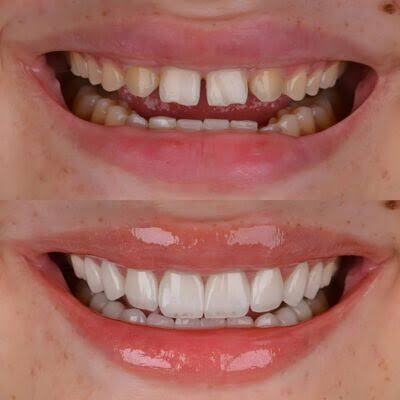 Porcelain Veneers